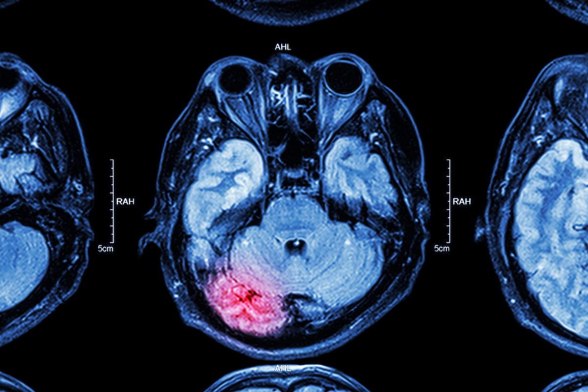 mri of brain injury